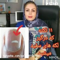 11 نکته لکه های سفید روی ناخن