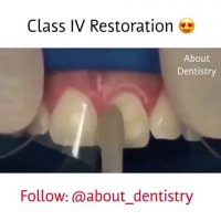 لمینت دندان-دکترمجیدقیاسی دندانپزشک زیبایی مشهد