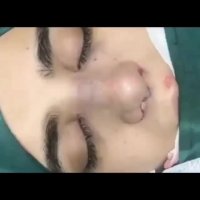 فیلم نمونه جراحی زیبایی بینی