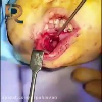 جراحی شکستگی فک