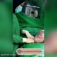 فیلم توده تخمدان