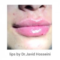 فرم دهی لب با تزریق زل هیالورونیک اسید