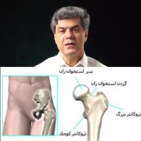 همه چیز در باره شکستگی لگن