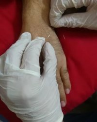 77740928 فیزیوتراپی در شرق تهران فیزیوتراپی در شرق تهران فیزیوتراپی در تهرانپارس 190 غربی علیدوستی پلاک 1 واحد 7 ساختمان رادین دکتر کاظمی آزاد سازی چسبندگی زخم بعد جراحی با سوزن درمانی