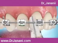 نحوه ی مسواک زدن دندان های ارتودنسی شده