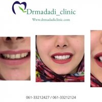 ونیر کامپوزیت فک بالا