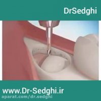 کشیدن دندان عقل