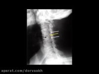 گردن درد موبایلی