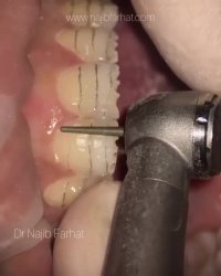 تراش دندان برای لمینت