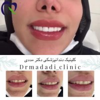 فیلم  ونیر کامپوزیت فک بالا