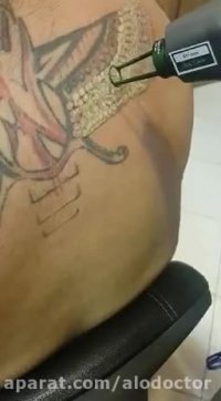 از بین بردن تاتوهای ناخواسته و ملاسما