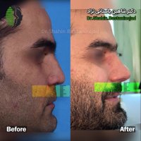 صحبت های دکتر باستانی نژاد درباره روش ابداعی در درمان بینی کوتاه