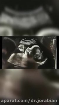 سونوگرافی سه بعدی جنین