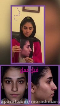 عمل زیبایی بینی