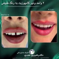 هزینه ونیر کامپوزیت