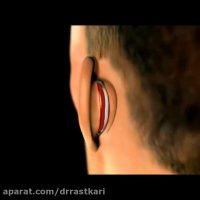 جراحی گوش برجسته