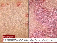 پسوریازیس رو‌در یک سال درمان کنید