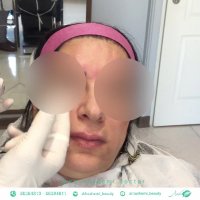 تزریق بوتاکس روی بینی