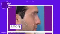 عکس قبل و بعد از عمل بینی آقایان