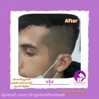 فیلم جراحی زیبایی بینی مردانه