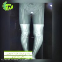 اصلاح اندام تحتانی