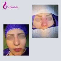 فیلم بیمار بلافاصله بعد از عمل بینی