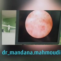 عمل هیسترکتومی