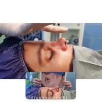 فیلم جراحی زیبایی بینی