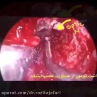 جزاحی دوبيني و تاري ديد و افتادگی پلک