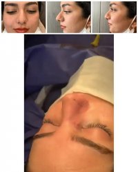 فیلم جراحی انحراف بینی