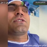 جراحی ترمیمی بینی برای افزایش طول بینی کوتاه