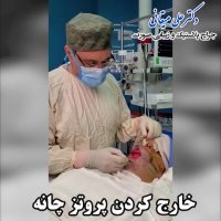 فیلم خارج کردن پروتز چانه