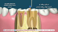 فضانگهدار_درمان ریشه_آبسه نوک ریشه