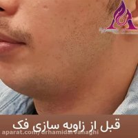 فیلم واقعی زاویه سازی فک با تزریق فیلر