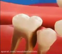 فیلم کشیدن دندان شیری