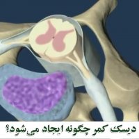 درمان دیسک کمر