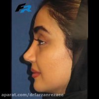 جراحی بینی نیمه فانتزی