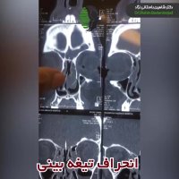 جراحی بینی نیمه گوشتی با انحراف شدید تیغه بینی | دکتر باستانی نژاد