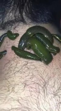 زالو درمانی برای میگرن ،  ریسک جراحی،  بزاق زالو