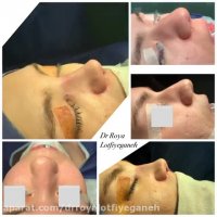 فیلم نتیجه جراحی بینی گوشتی