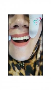 رضایت بیمار بعد از گذشت ۴ سال از ایمپلنت دندان
