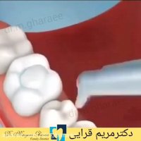 رفع پوسیدگی و ترمیم دندان با کامپوزیت