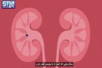 علت سنگ کلیه و راه های درمان آن