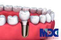 مراحل کاشت ایمپلنت دندان