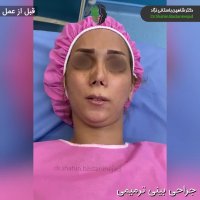 جراحی ترمیمی بینی با از بین رفتن کامل تیغه بینی | دکتر باستانی نژاد