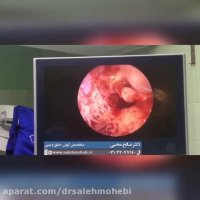 فیلم آندوسکوپی گوش