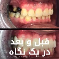 درمان ایمپلنت با لمینت دندان