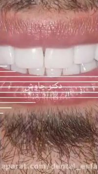 کامپوزیت دندان در اصفهان ، لمینت دندان در اصفهان ، بلیچینگ دندان در اصفهان