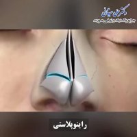انیمیشن رینوپلاستی