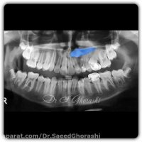 درمان دندان نهفته نیش افقی | دکتر سعید قریشی
